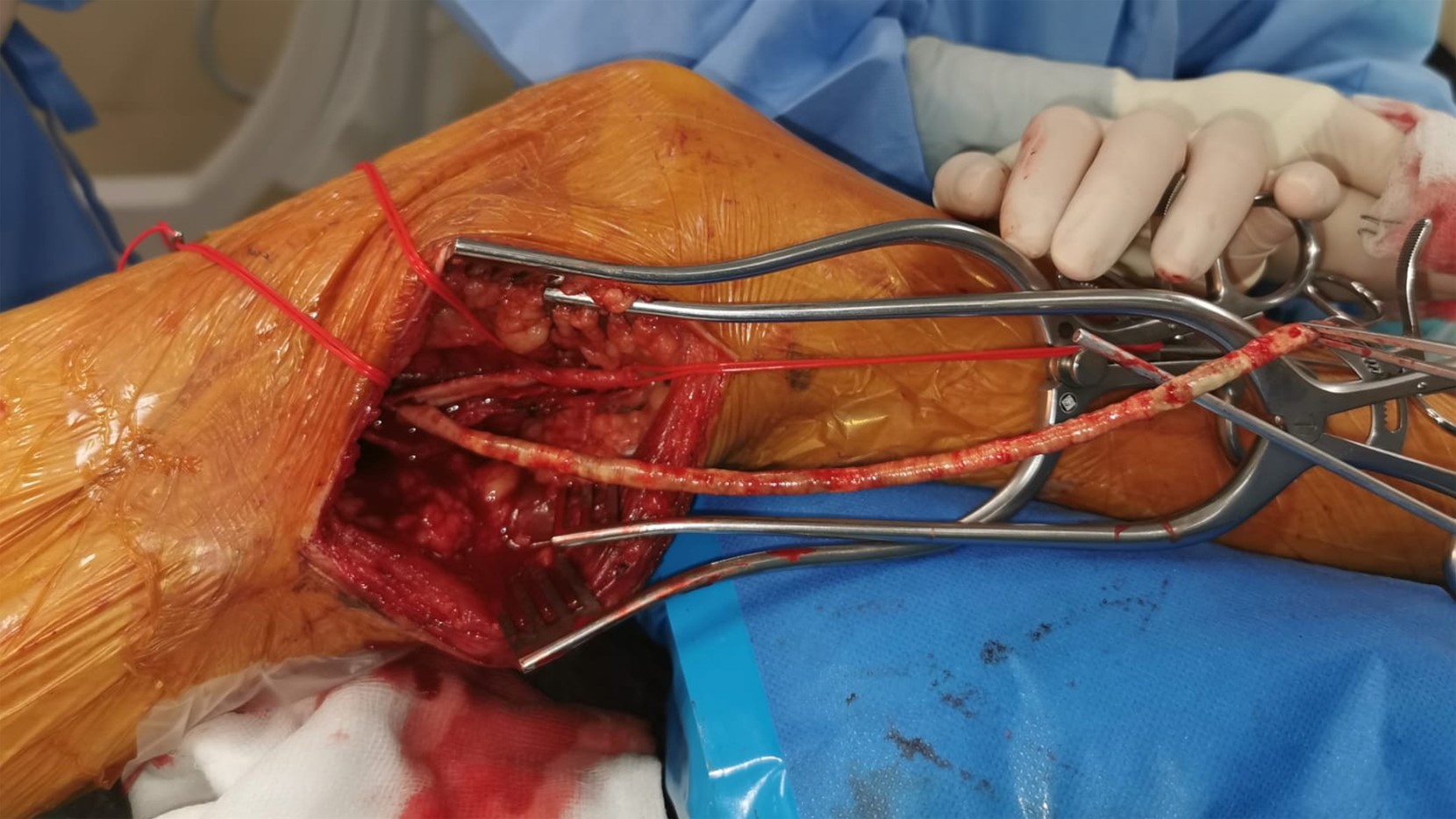 endarterectomy